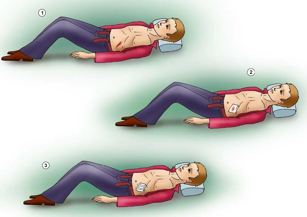 Помощь при ножевом. Оказание первой помощи при ранении живота. Оказание первой помощи при травме живота.
