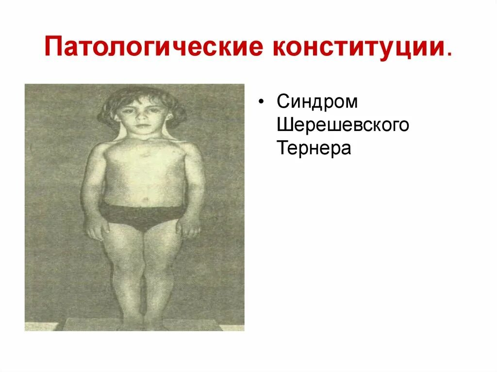 Синдром шерешевского тернера прогноз. Моногенные шерешевского. синдромшеревского тернера. синдром шерешевского тернера узи. синдром шерешевского тернера дети.