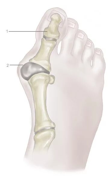 Усиленные суставы. Бурсит плюснефалангового сустава 1 пальца. Анатомия 1 плюснефалангового сустава. Бурсит 1 плюснефалангового сустава. Вальгусная деформация плюснефалангового сустава.