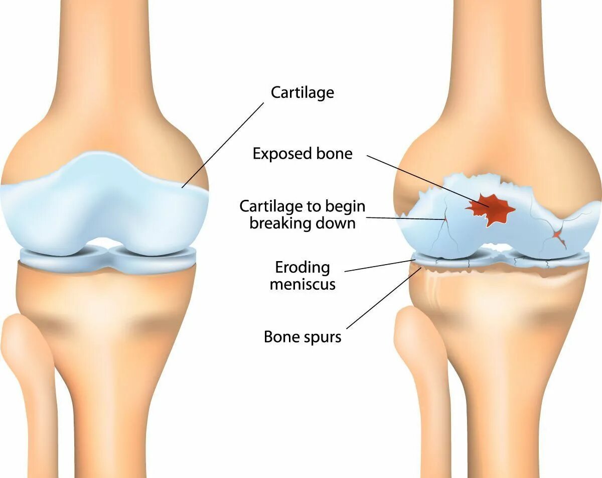 Деформирующий остеоартроз коленного сустава. Гонартроз остеоартроз. Артроз коленных суставов (гонартроз). Что разрушает суставы