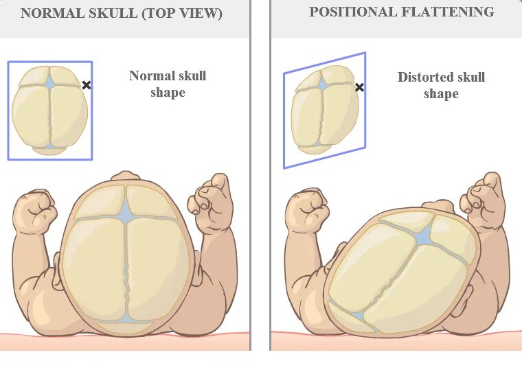 Череп детей при рождении. Краниосиностоз краниостеноз. Череп детей при рождении. Череп детей при рождении. Темечко у новорожденных.