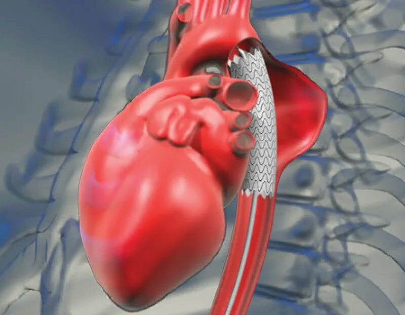 Болит стент. Аневризма аорты сердца. Стентграфты грудной аорты. Стентирование аорты сердца.