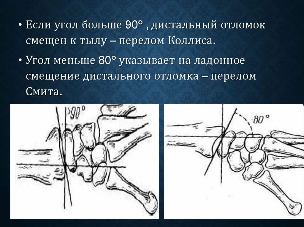 Разрыв кости. Перелом Смита и Коллиса угол. Перелом дистальной части предплечья.