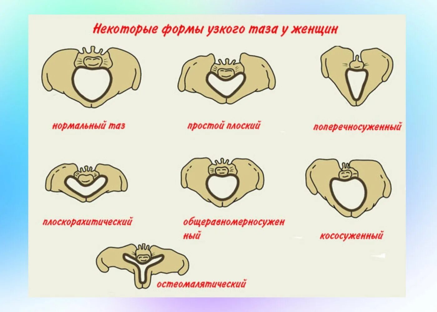 Каких двух родов были мужчины перечислите. Сужения таза в акушерстве. Классификация формы сужения таза Акушерство. Классификация узкого таза Акушерство. Анатомический узкий таз и клинически узкий таз.