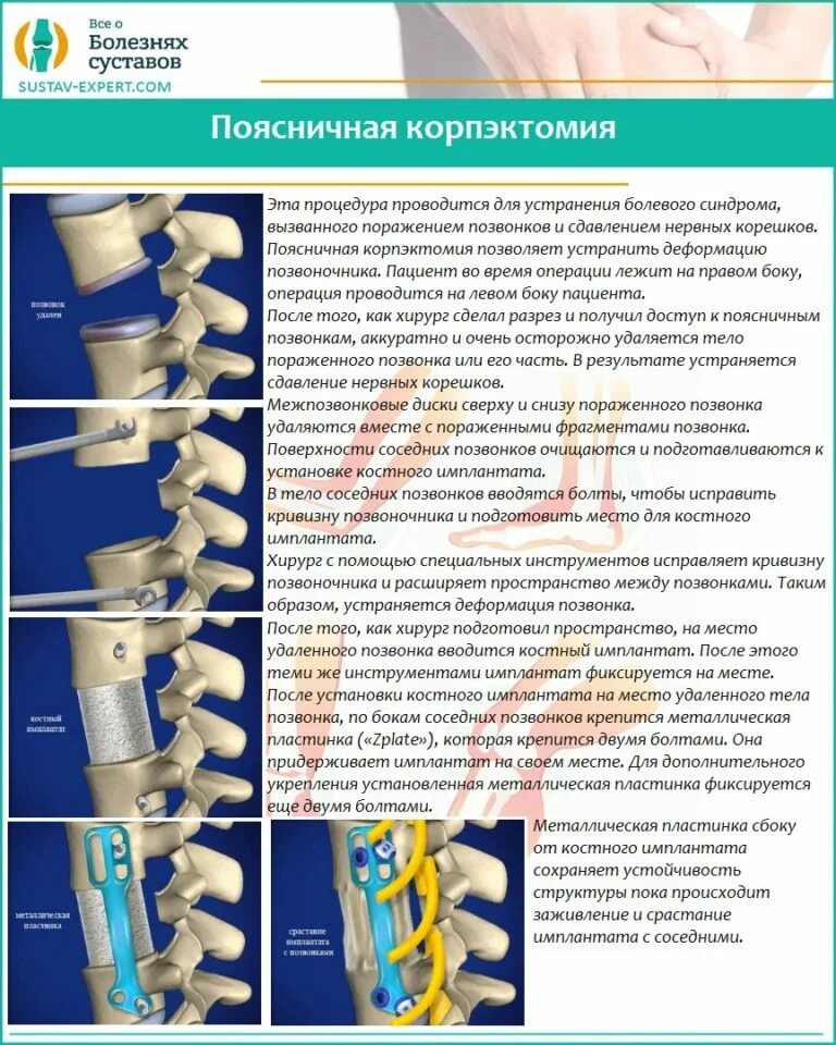 Имплант позвоночника поясничного отдела. Конструкция в позвоночнике. Импланты позвоночника поясничного отдела. Имплант диска шейного отдела позвоночника. Операция на позвоночнике отзывы пациентов