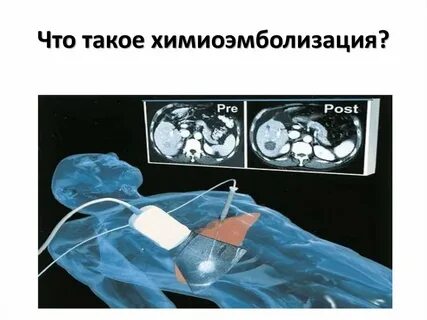 Химиоэмболизация печени отзывы