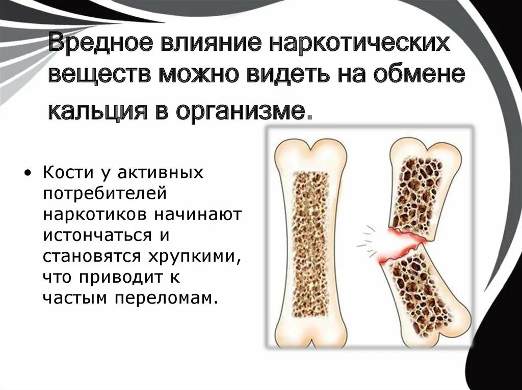 Почему кости легкие. Влияние наркотиков на костную систему. Как влияют наркотики на кости. Влияние наркотиков на организм. Влияние наркомании на скелетную систему.