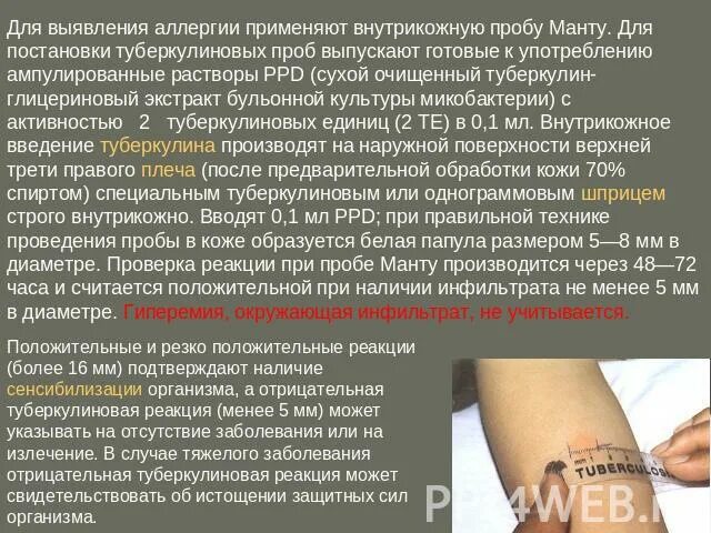 Гиперергическая реакция на пробу манту. Туберкулинодиагностика реакция манту. Туберкулиновая проба аллергическая реакция. Аллергическая проба манту. Резко положительная реакция