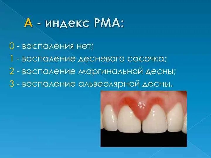 Индекс десна. Воспаление десневых сосочков. Воспаление десневого сосочка. Воспаление межзубных сосочков.