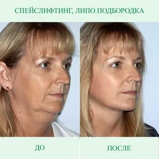 Нижний смас