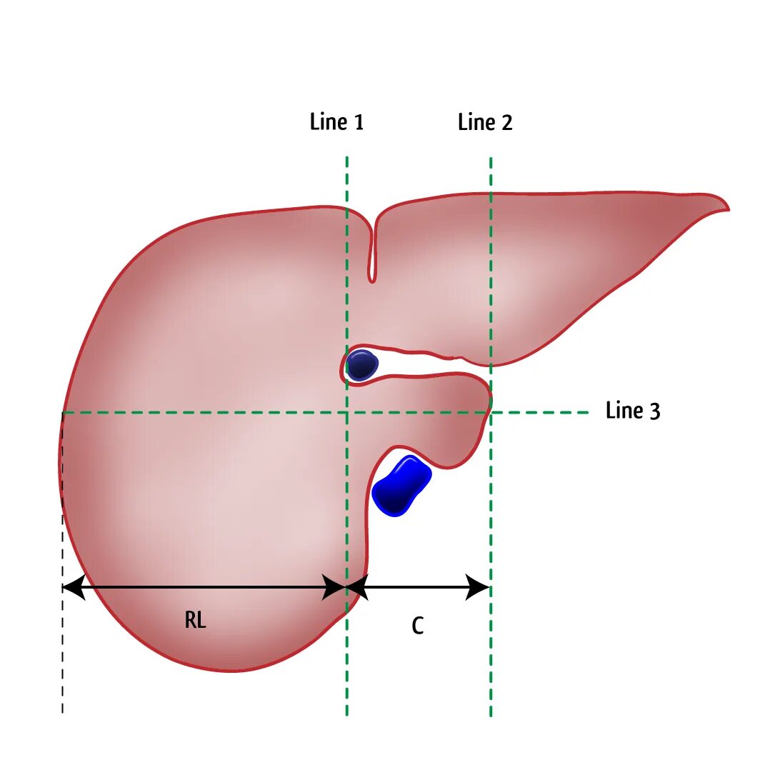 Вертикальный размер правой доли печени норма. Передне-задний размер правой доли печени норма. Размеры долей печени. Передне-задний размер левой доли печени норма. Какие нормальные размеры печени
