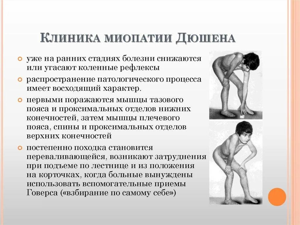 Симптомы спинальной мышечной. Синдром мышечной дистрофии дюшенна. миопатия пояснично конечностная. мышечная дистрофия дюшенна лекарство. миопатия односторонняя.