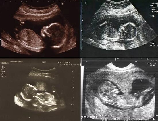 17 неделя отзывы. 17ая неделя беременности. 17 Недель беременности фото ребенка. 16 Акушерская неделя беременности.