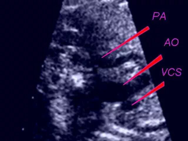 срез через 3 сосуда у плода на узи. узи шейной складки. правая аберрантная подключичная артерия у плода на узи. четырехкамерный срез сердца плода. фронтальный срез узи.