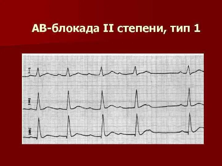 Блокада на первом. АВ блокада 2 степени Мобитц 1 на ЭКГ. АВ блокада 1 степени на ЭКГ. Атриовентрикулярная блокада Мобиц 1 ЭКГ. Av блокада 1 степени Мобиц 1 ЭКГ.