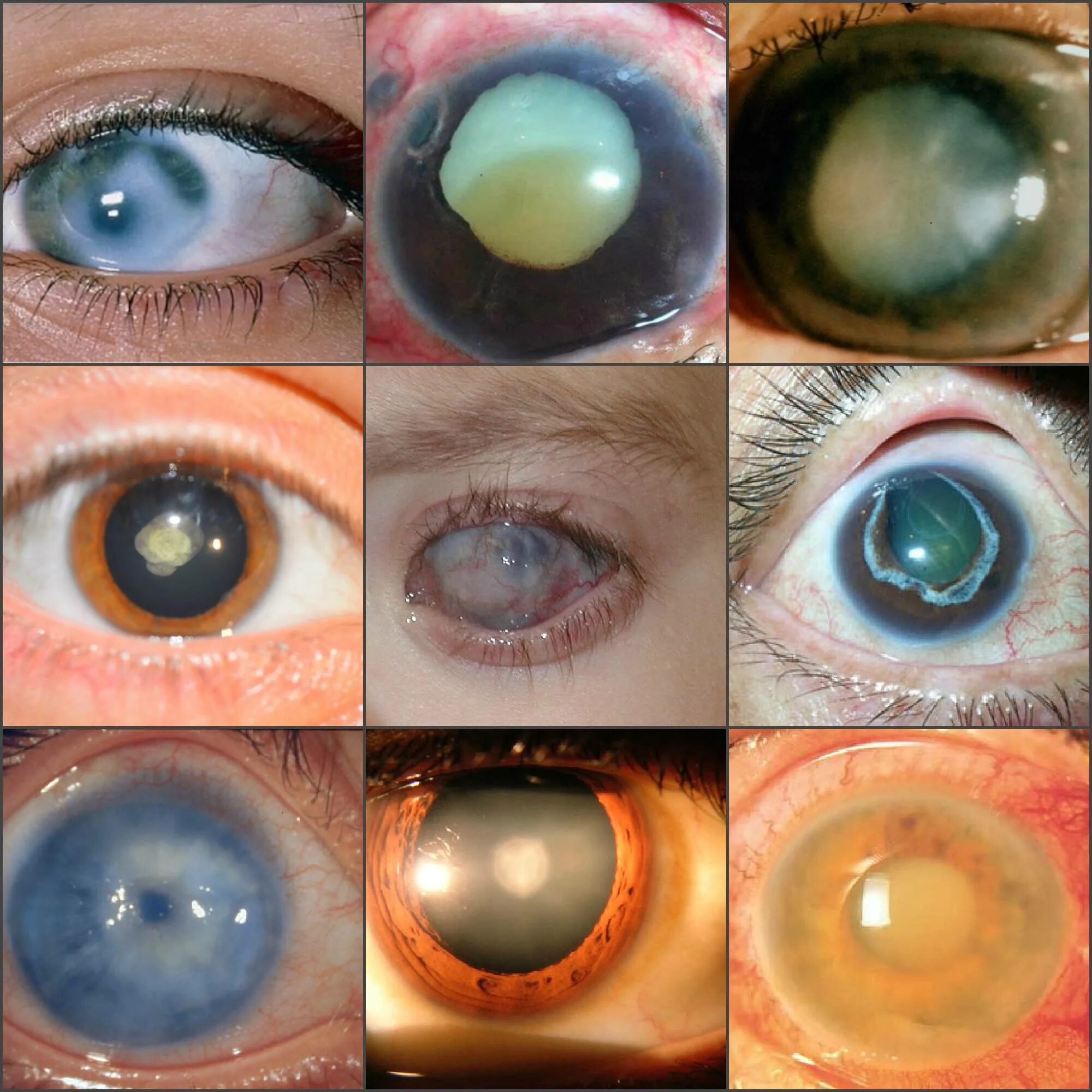 Факолитическая катаракта. Миопизирующая катаракта. Закрытоугольная глаукома глаза. Факоморфическая катаракта. 1 признаки катаракты