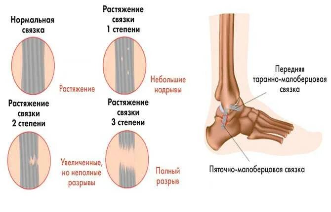 Сколько времени заживает нога. Растяжение и разрыв связок степени. Растяжение голеностопа 1 степени. Синдесмоза голеностопного связки. Растяжение связок голеностопного сустава клиника.