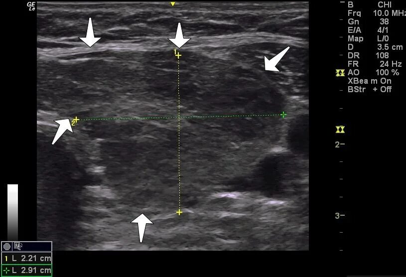 Щитовидная железа узи лимфоузлы. Изоэхогенный узел щитовидной железы что это такое. Анэхогенный узел щитовидной железы. Гипоэхогенные узлы щитовидной железы. Загрудинный узел щитовидной железы . УЗИ.