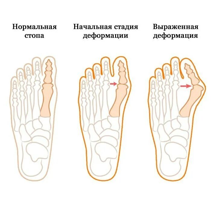 Деформация хода обеих. Вальгус деформация большого пальца стопы. вальгусная деформация косточки. вальгусная деформация 1-го пальца стопы. вальгусная деформация стопы 1 степени.