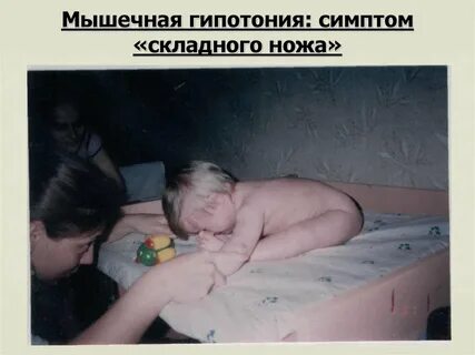 Сниженный тонус мышц