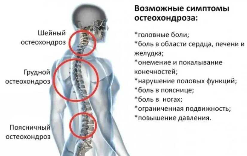 Вызывает сильнейшие боли в. Симптомы шейно-грудного остеохондроза у мужчин. Шейный остеохондроз симптомы ощущение. Остеохондроз шейного отдела симптомы. Симптомы хондроза грудного отдела.