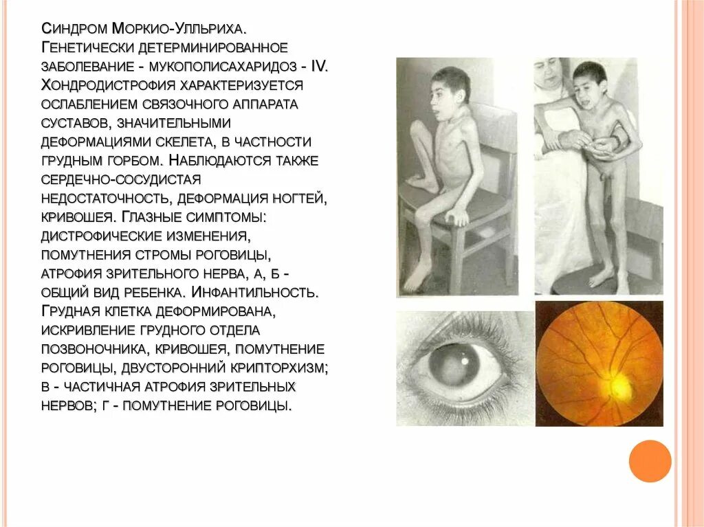 Детерминированный синдром. Мукополисахаридоз моркио. мукополисахаридоз тип iv. болезнь моркио. мукополисахаридоз 6 типа синдром марото лами. мукополисахаридоз синдром моркио.