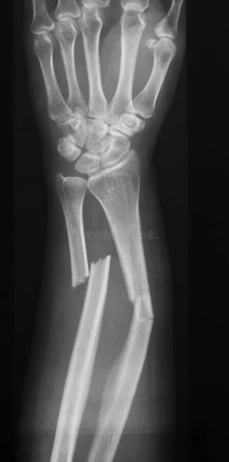 Radius fracture