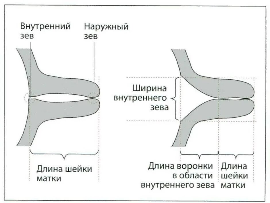 Что значит зев закрыт. Измерение длины шейки матки схема. Норма толщины шейки матки при беременности. Шейка матки Размеры норма при беременности. Ширина цервикального канала 2 мм.