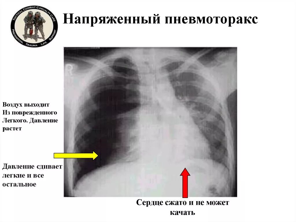 Воздух выходит из легких