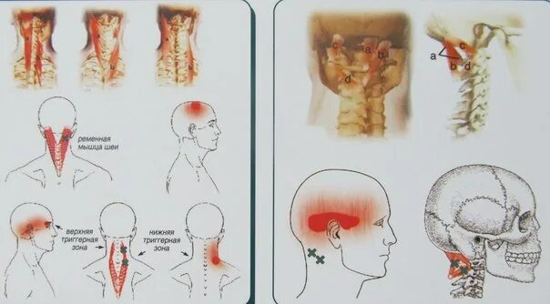 Болит затылок головы и шея. Напряжение в затылочной части головы. Болит голова в затылочной части. Головная боль напряжения. Болит справа внизу головы