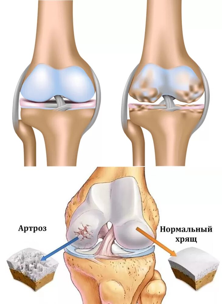 Артроз коленного сустава название