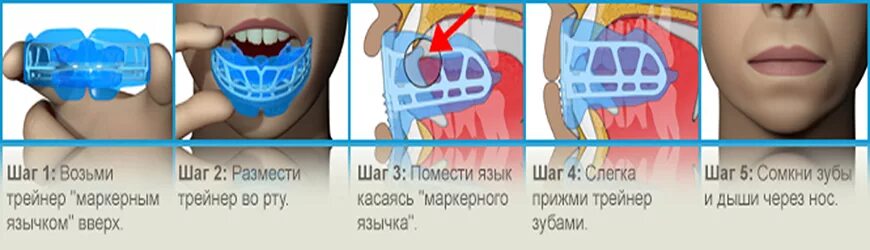 Аномалии трейнер. LM активатор Миобрейс. Ортодонтический LM-активатор. Аппарат Миобрейс ортодонтия. Трейнер LM активатор.