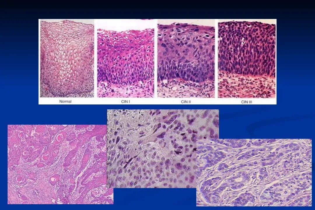Плоскоклеточная карцинома шейки матки гистология. Плоскоклеточная карцинома матки микропрепарат. Псевдоэрозия шейки матки гистология. Кондилома шейки матки гистология. Инвазивный рак шейки