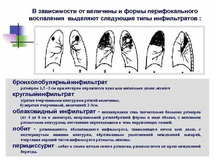 Легочный инфильтрат классификация. Формы инфильтративного туберкулеза. Инфильтрация легочной ткани на кт. Альвеолярный тип инфильтрации при пневмонии. Синдром инфильтрации легочной ткани рентген.
