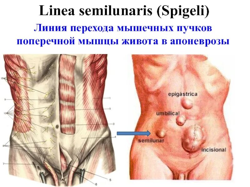 Грыжа спигелиевой линии. Спигелиевая грыжа живота. linea semilunaris живота. грыжи полулунной спигелиевой линии.
