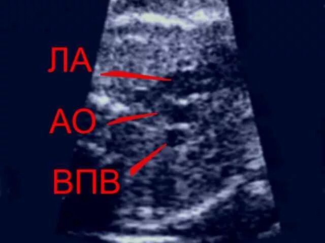 срез через 3 сосуда у плода норма. перимембранозные дефекты межжелудочковой перегородки. тетрада фалло эхо кг. срез через 3 сосуда затруднен. аберрантная подключичная артерия на узи.