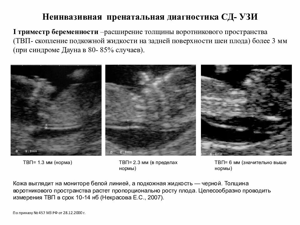 Как отличить на узи