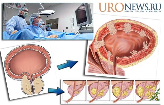 Трансуретральная резекция аденомы предстательной железы. Трансректальная биопсия предстательной железы. Трансуретральная резекция мочевого пузыря. Трансуретральная биопсия предстательной железы. Операция простаты последствия отзывы