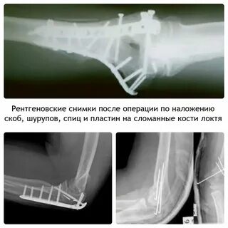 Снятие пластины после перелома