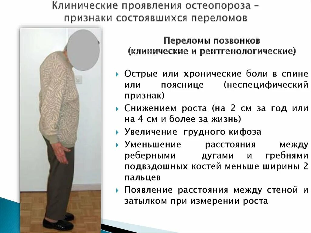 Остеопороз у мужчин причины