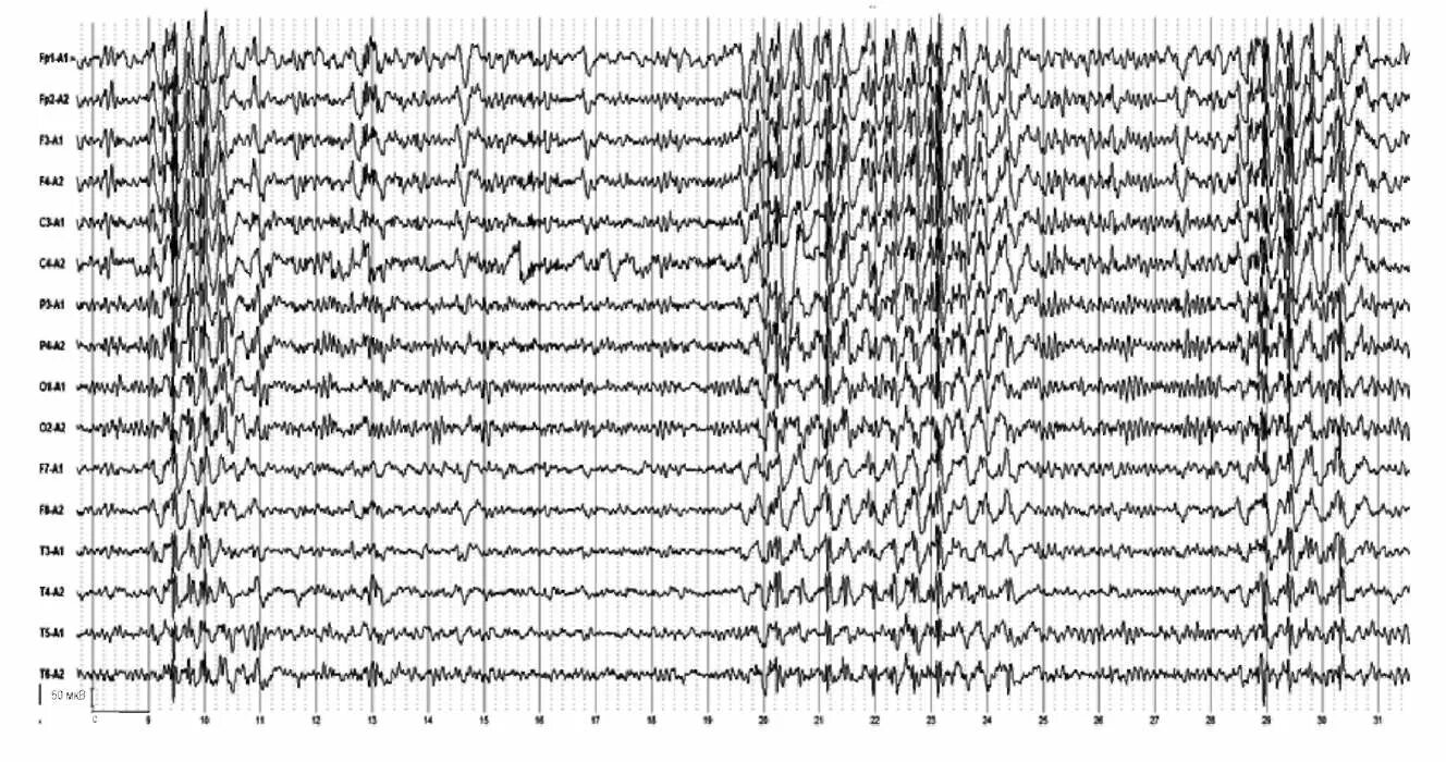 Активность ээг у ребенка что это. Эпилептиформная активность на ЭЭГ. Спайк волна на ЭЭГ. Генерализованная эпилептиформная активность на ЭЭГ У ребенка. Полиспайки на ЭЭГ.