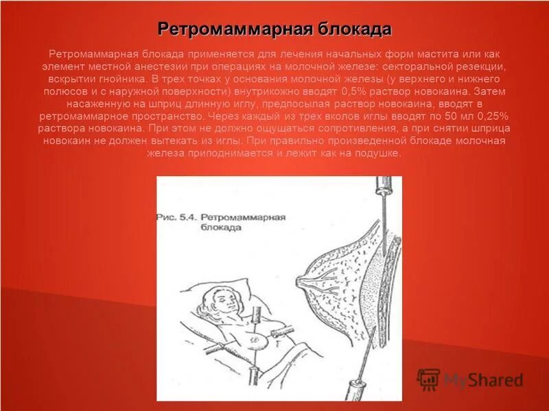 Острый гнойный мастит. Ретромаммарная новокаиновая блокада. Ретромаммарная блокада молочной железы. Новокаиновая блокада молочной железы. Прокаиновые  блокады молочной железы.