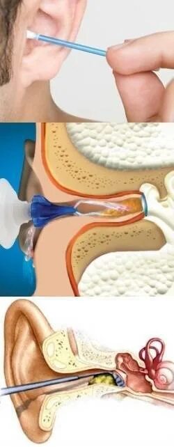 Заложило ухо серой что делать. Серная пробка отоскопия. Анатомия уха серная пробка.