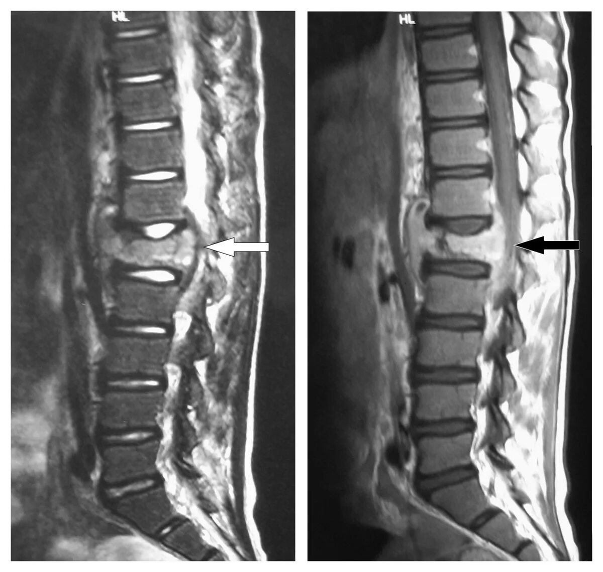 Мрт поясничного отдела подготовка к процедуре. Мрт l spine. межпозвонковый остеохондроз поясничного отдела. мрт позвоночника остеохондроз. позвоночник t1 t2.
