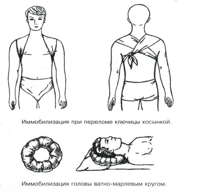 Шина для лечения переломов ключицы. Ватно марлевый круг для иммобилизации. Транспортная иммобилизация ватно марлевый круг. Осуществление транспортной иммобилизации при переломе ключицы.. Транспортная иммобилизация при травме (переломе) ключицы.