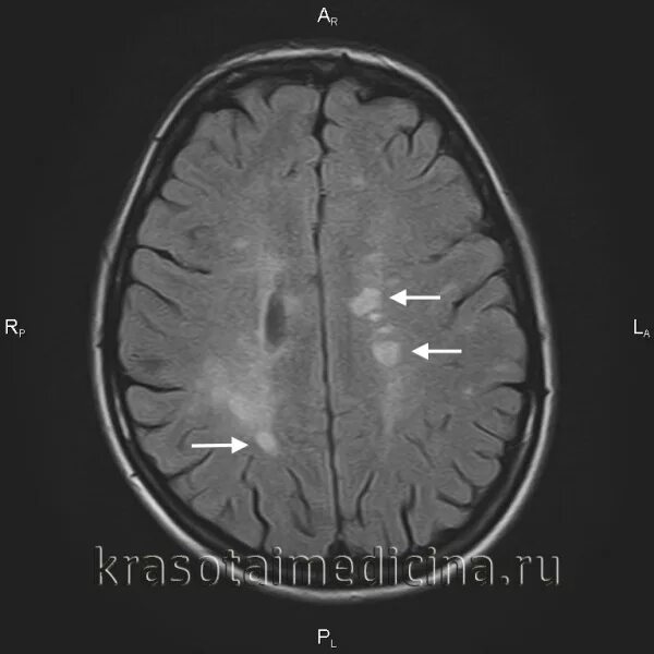 Очаги глиоза рассеянный склероз. Мрт мозга рассеянный склероз. Рассеянный склероз на мрт головного мозга. Глиоз головного мозга. Многоочаговое поражение головного мозга