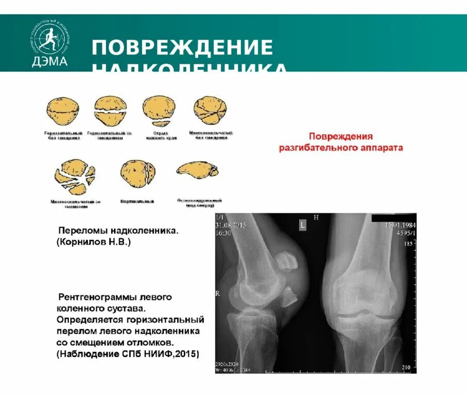 Травма надколенника коленного сустава. Переломы надколенника классификация. Типы перелома надколенника. Перелом надколенника рентген. Перелом надколенника операции