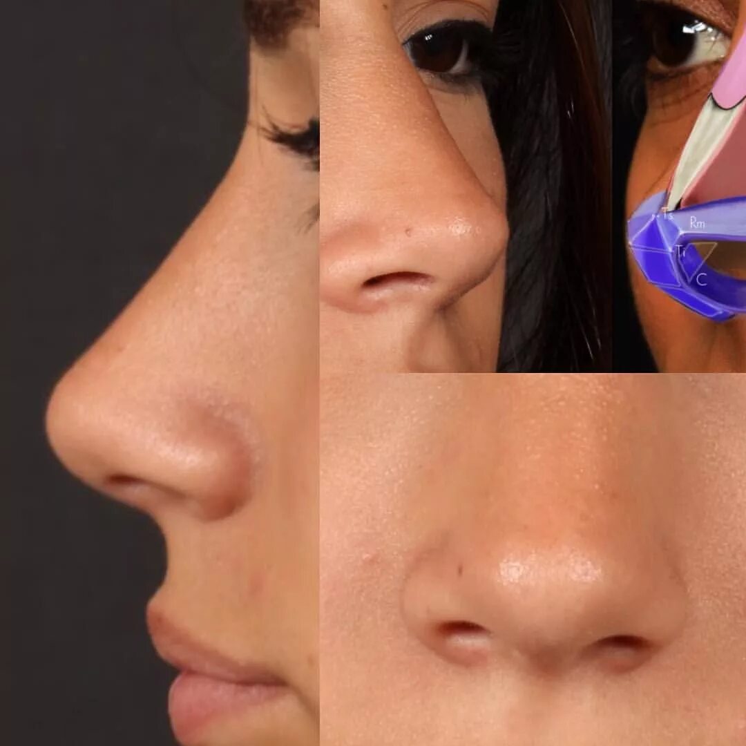 Где можно сделать нос. Аугментационная ринопластика. Аугментационная ринопластика носа. Операция носа ринопластика.