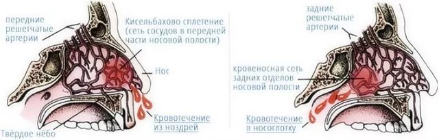 Насморк. Как появляется слизь в носу. Течёт из носа что делать. Постоянно бежит из носа. При массовом кровотечении.