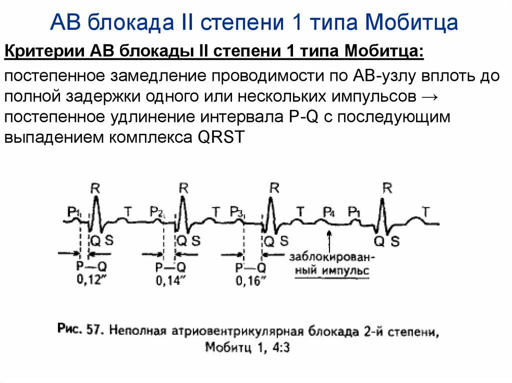 Атриовентрикулярная блокада 2. АВ блокада 2 степени Мобитц 1 критерии. Критерии АВ блокады 2 степени. ЭКГ критерии АВ блокады 2 степени Мобитц 1. Av блокада 1 степени критерии.